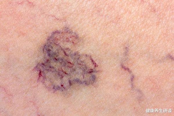 |运动可以改善血栓吗?结合3件事,逐步把血栓“击碎”