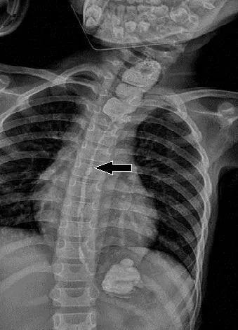 美芽妈妈 9岁女孩喝了“一口水”，导致食管报废，元凶很多家里都有