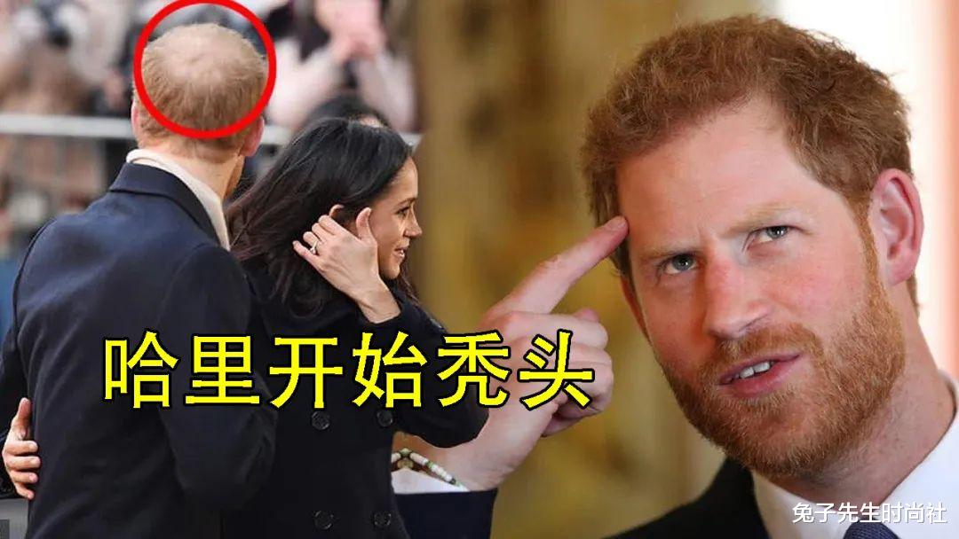 长寿与衰老 37岁梅根进“头发诊所”，为一头秀发花巨资，又拖上哈里告别秃头