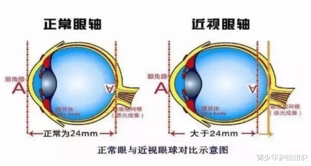青少年护眼知识|教你如何根据当前孩子眼轴长度，计算未来孩子可能发展的近视度数