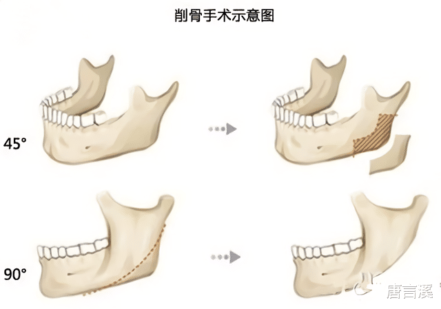 朱芊佩|那些削骨“一刀切”的明星还好吗？有的已垮掉，小方脸成最后赢家