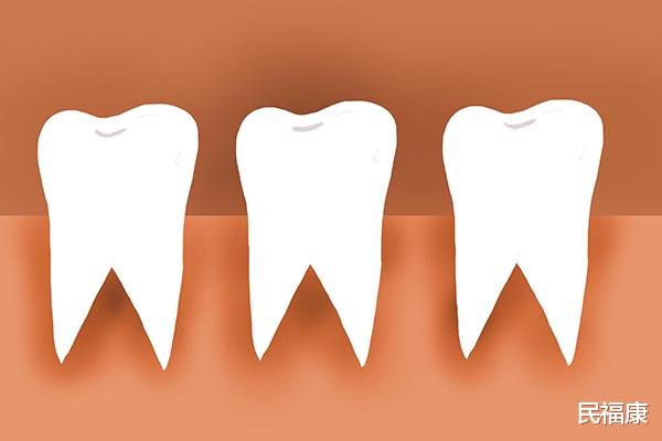 饮食|“洗牙后牙齿会变松、牙缝会变大”关于洗牙的谣言,您信了几条?