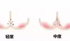 我是妈妈|夏季来临,宝宝红屁屁“成灾”,家长做好日常护理,娃才不会受罪