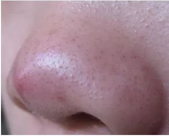 发型 脸上的红血丝，应该如何修复？红血丝超详细的解析