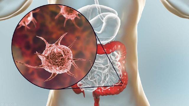 大肠癌|大肠癌到来之前，身体会发出3个“信号”，你该早一点了解