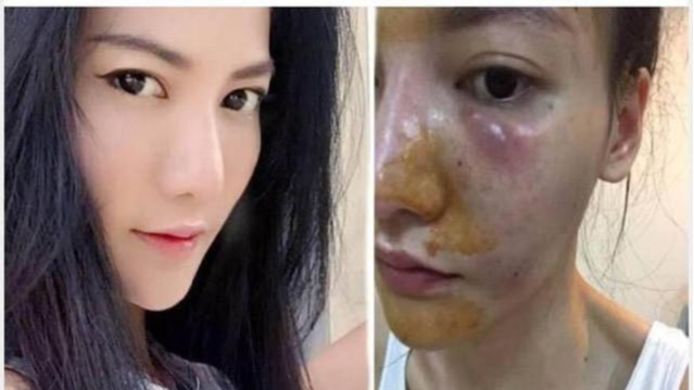 好物官|泰国连续打6年“美白针”的女子！如今怎么样了？网友：难以置信
