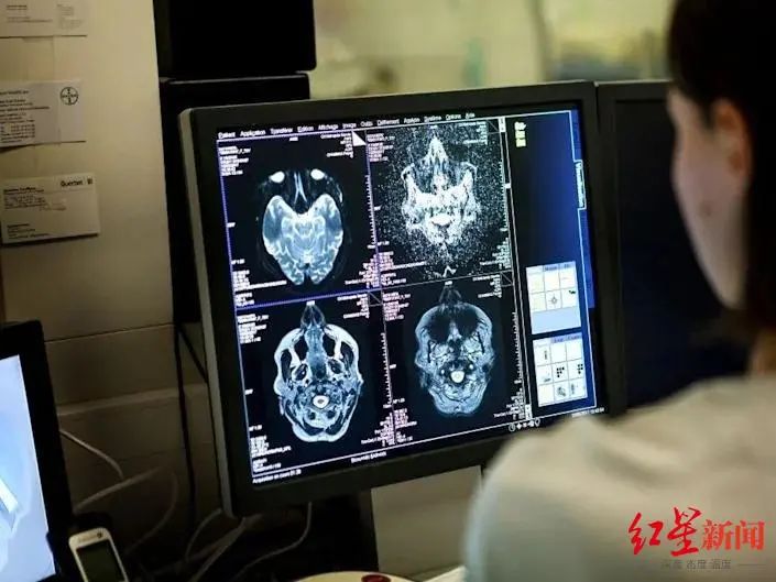 84%感染者出现后遗症,美国研究发现:新冠还能杀死脑细胞