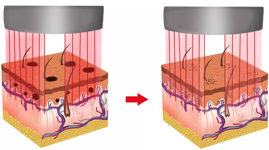 小美说美|为什么做完光电美容项目后会反黑?