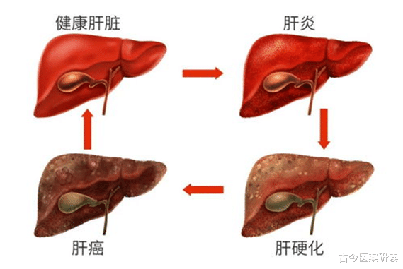 古今医案研读|身体这1处发黑，与肝毒过多有关系！想让肝脏健康，多做这些事