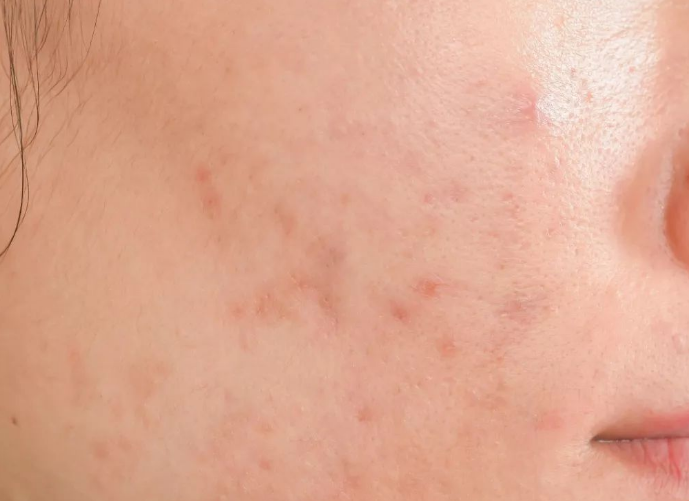 偷衣|小葵花痘痘课堂开课啦，小痘痘反反复复老不好，多半是。。。