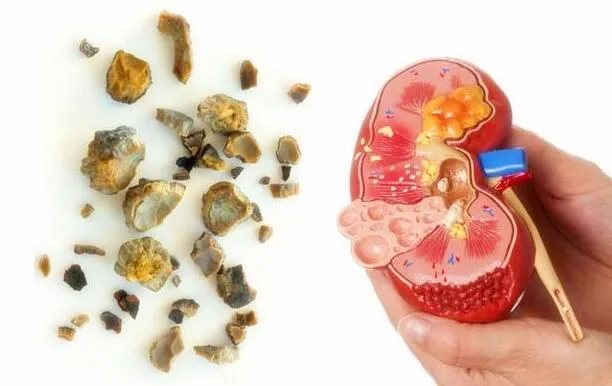 尿路感染|你是什么结石类型?吃不对,当心结石复发