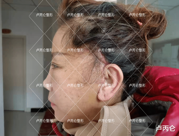 后遗症|拉皮术后可能会出现哪些问题?术后有哪些后遗症