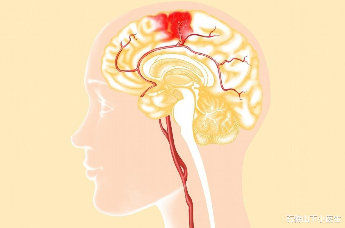 石佛山下小医生|脑出血来临，身体有什么症状？哪些人更容易发生脑出血？