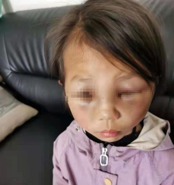 视野新闻周刊 云南女童疑遭继母虐打，生父称无能为力自己也很受气，继母因怀孕未被采取强制措施