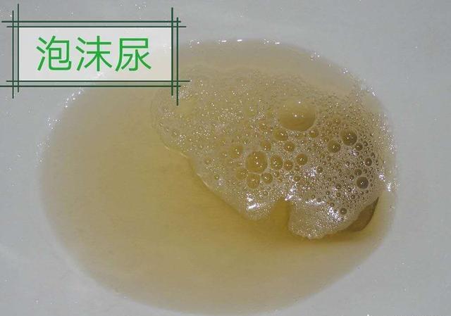 蛋白尿|泡沫尿是否等于蛋白尿?泡沫越多说明蛋白尿越严重吗?