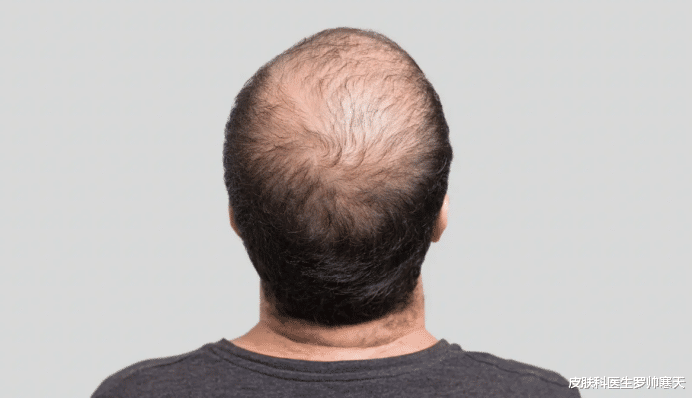 肾病|脱发能够恢复吗?8种常见性脱发,快收藏