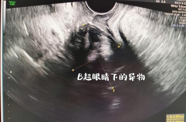 女大学生 19岁女大学生和男友玩花样，5cm长异物塞入体内足足一个月！