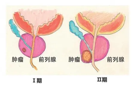 科瑞泰q医 男性最重要的健康不能不看!带你认识前列腺癌!