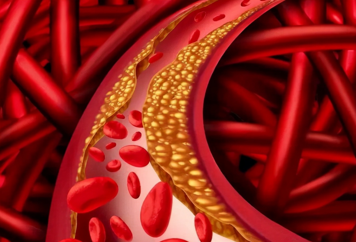 胆固醇|脑供血不足，身体会出现4个信号，2招学会，胆固醇稳降