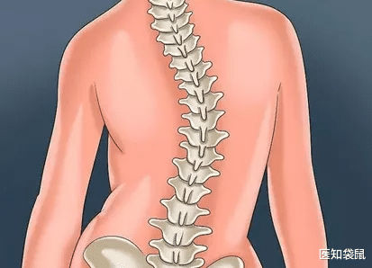 医知袋鼠|脊柱侧弯危害多，100个人就有3个中招！教你一招来判断