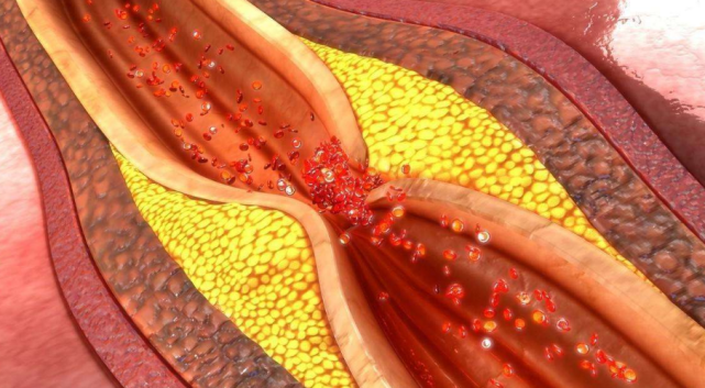 内科|55岁大姐常吃一“零嘴”，血脂慢慢降低，内科主任：家中有老人可以学起来