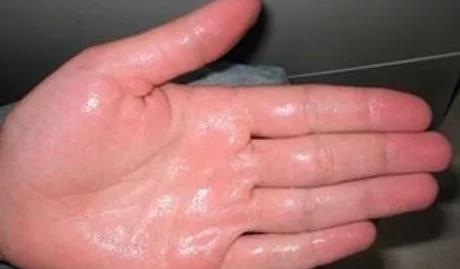 百艾堂|立秋以后出汗不等于排毒！这7种汗要注意