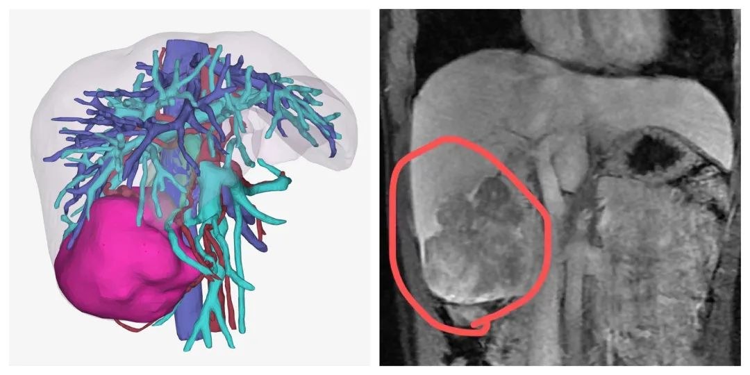 肝癌|22岁女孩查出巨大肝癌，提醒：无端出现4种症状，或是乙肝变肝癌