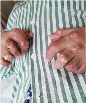 尿酸|医生：尿酸高，很伤身，3种食物是“大忌”，不要自讨苦吃