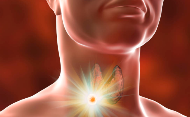 甲状腺结节|甲状腺的“知音”已找到,并非无花果,甲乳科主任:你若爱吃,结节无处藏身