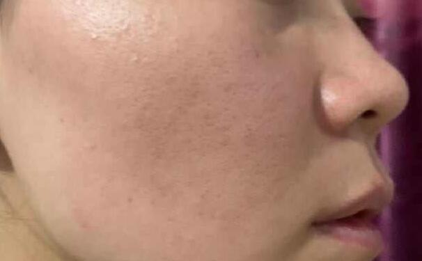 粉刺 你知道为什么会长粉刺吗?记住这几点和粉刺说拜拜