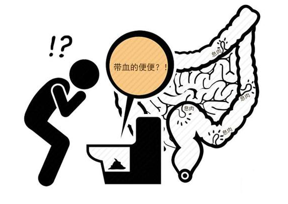 癌细胞|大便是癌症的“播报员”？医生：拉出4种大便，可能与癌细胞有关