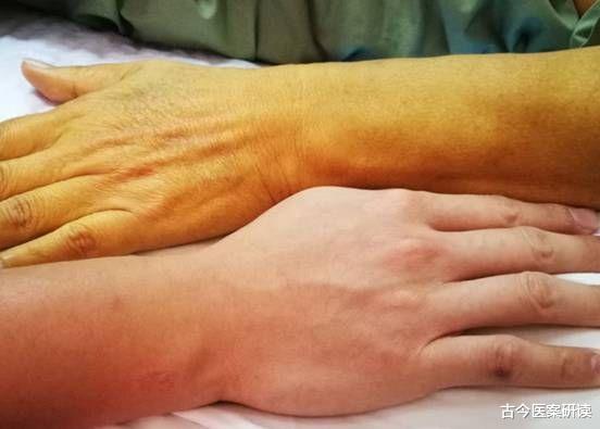 古今医案研读 吃一次等于喝3次马桶水，19岁学生肝癌晚期，医生：这1素食怎能天天吃