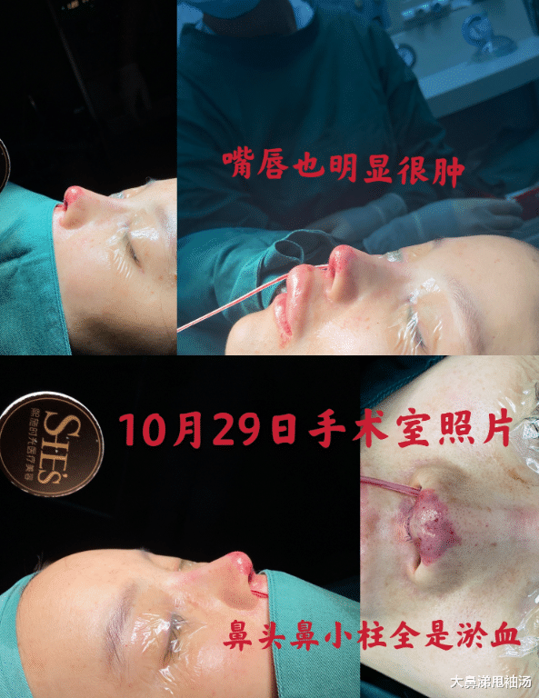 整容|断送演艺生涯？女演员整容失败致鼻头坏死，一度想要跳楼自杀