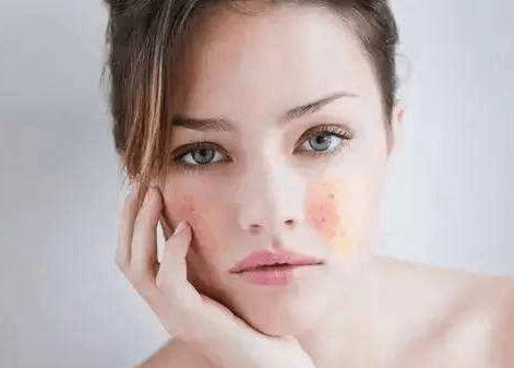 皮肤易泛红?别着急,教你一招解决