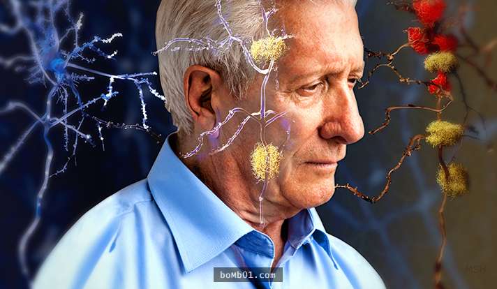 彗星 脑组织炎症是导致阿尔茨海默病的关键因素