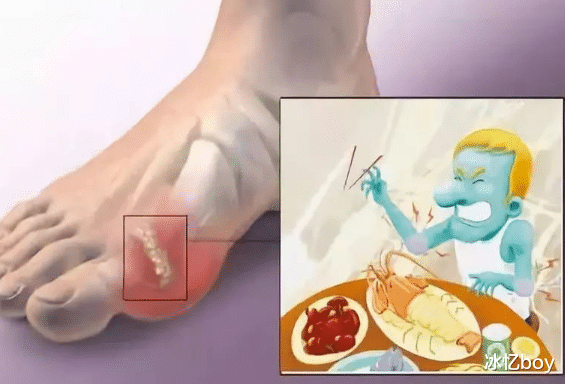 羊肉|羊肉是痛风的“发物”?提醒:尿酸高的人,这2物也不能多吃