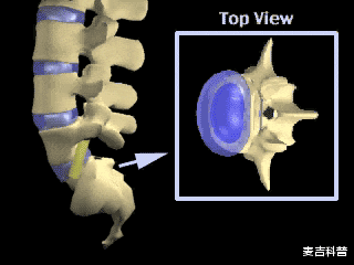 腰椎间盘突出|腰椎间盘突出患者注意了，这五个“误区”，一定要避免