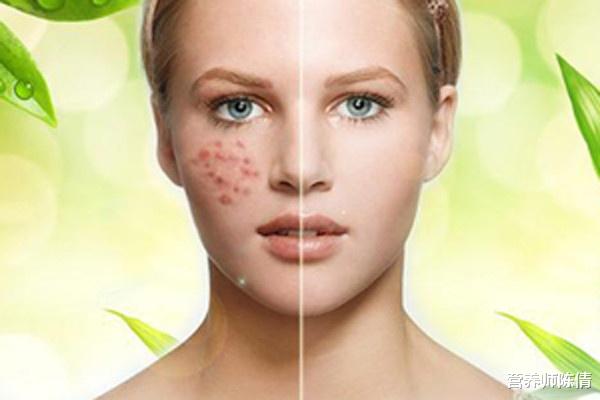 营养师陈倩|毛孔粗大成难题:女生毛孔粗大真的没救了吗?