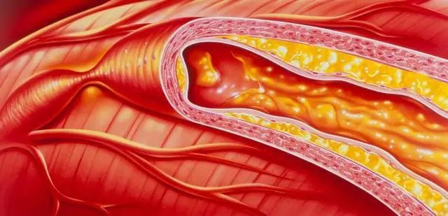 景焕粒子能|粒子能细胞康复液可修复损伤的血管,预防动脉粥样硬化!