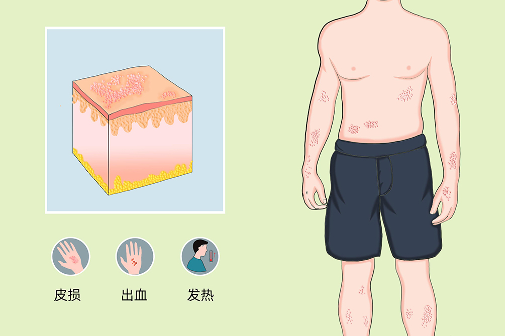 小思医生|糖尿病患者多少体重最好,一套计算公式,医生教给你