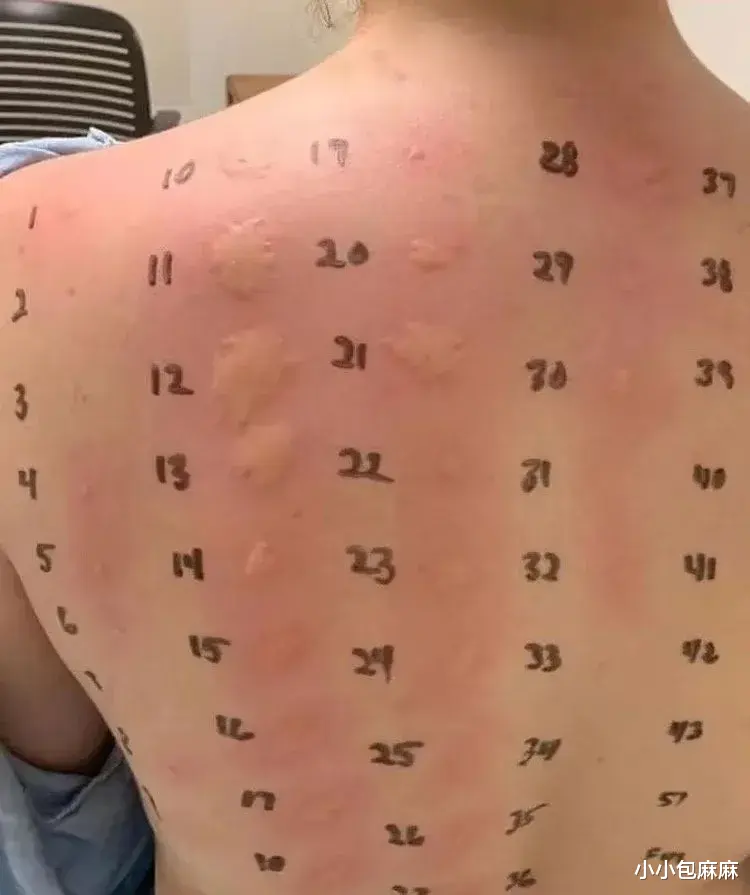 小小包麻麻|家有过敏娃是种怎样的体验？权威的儿科医生建议来了…