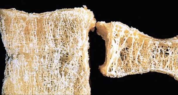 金兰中医学社|骨质疏松“祸首”被找到，烟酒排末尾，榜首若你爱吃，骨骼或成“蜂窝”