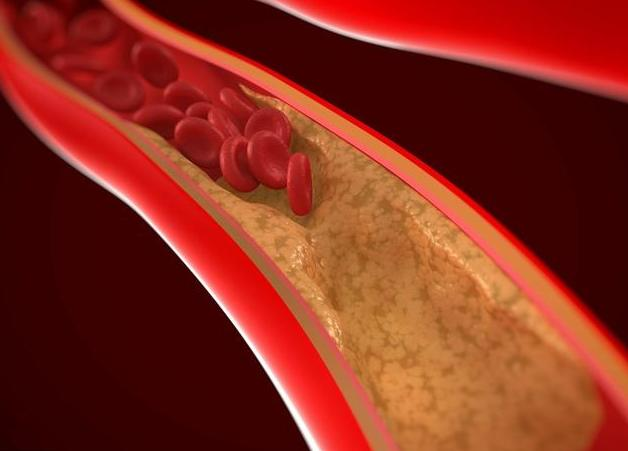 中药|让血管“回春”的不是黑芝麻，内科主任：你若喜欢吃，血管或会更通畅