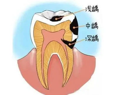 蛀牙|人到中年，骨质疏松，导致龋齿变多？