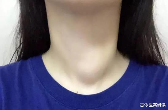 古今医案研读|20岁小姑娘，天天宅在家，竟患上甲状腺癌，医生：1个习惯害了她