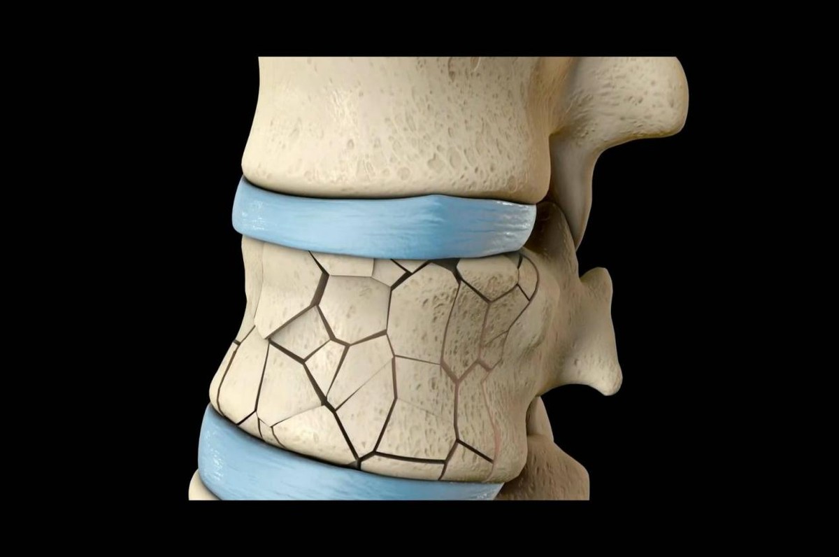 骨质疏松|吃一口等于5斤黑芝麻，医生：若你能常吃，人老骨头硬或不是空话