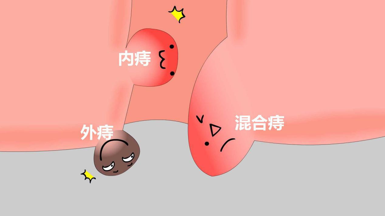 球探铭老师|夏天痔疮便血怎么办？选对这些痔疮膏让你不再忧愁！