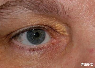 高血脂|高血脂并不可怕，坚持这3个降脂“小妙招”，给血管来个大扫除