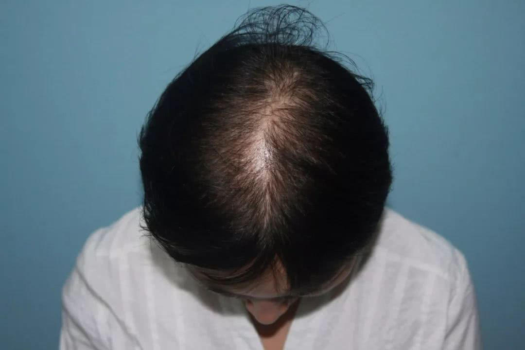 心脏|想要改善脱发现象，可以这样做！