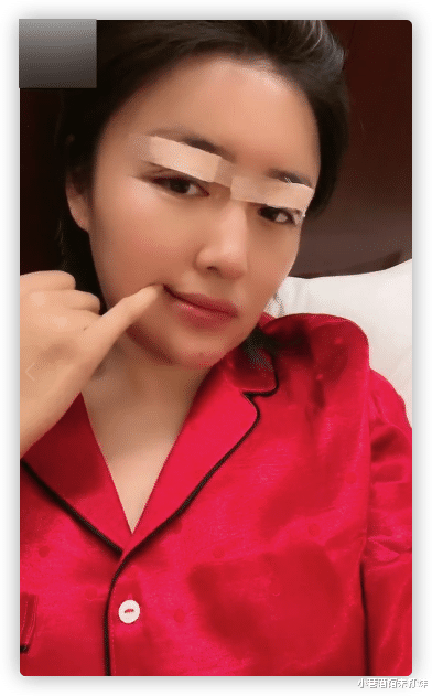 整容|本山传媒娇娇自曝整容，晒术后照被指认不出，多次割眼皮肿胀明显